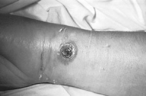 A patient with a cutaneous anthrax lesion on the arm. 
