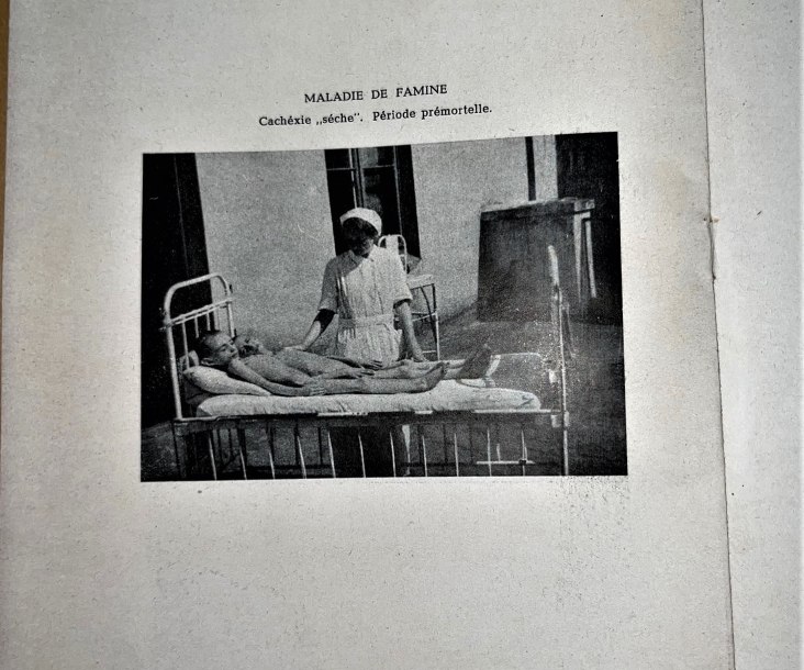 The book includes haunting photos from inside the ghetto, along with its record of the medical effects of starvation. 'Maladie de Famine," American Joint Distribution Committee
